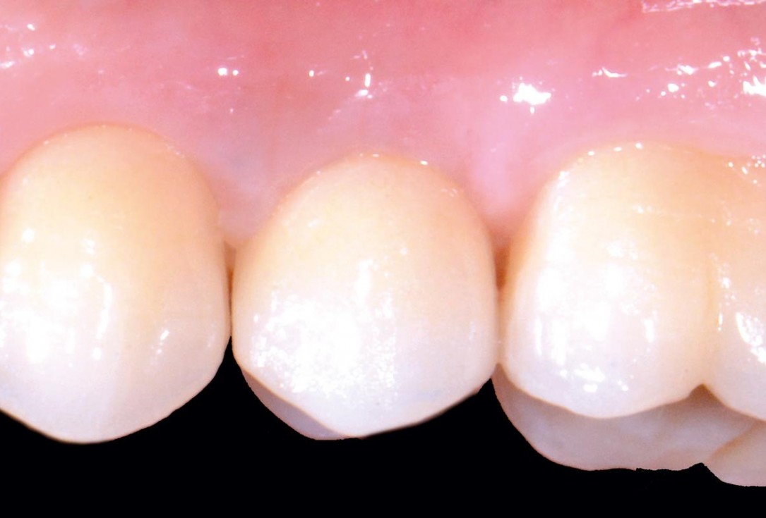 Full bone regeneration in extraction socket augmented with maxgraft® and Jason® membrane – Dr. C. Landsberg