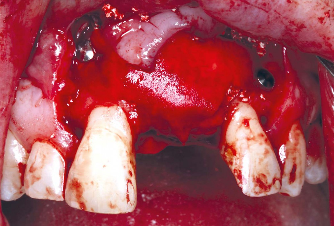 Block grafting in the aesthetic zone with maxgraft®, Jason® membrane and cerabone® - Dres. H. Maghaireh and V. Ivancheva