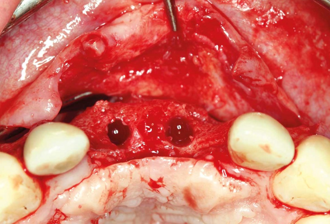 Ridge augmentation in the maxilla with maxgraft® bonebuilder in the aesthetic zone - Dr. M. Kristensen