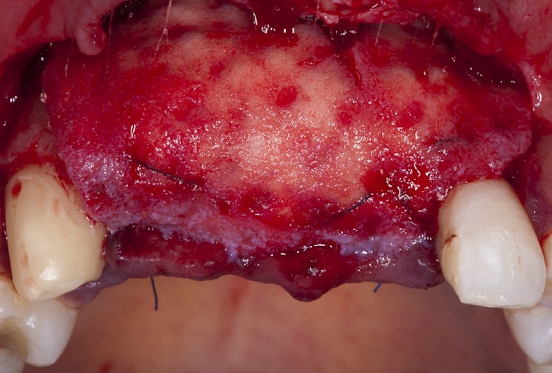 Block augmentation with maxgraft® block and mucoderm® - Dr. K. Chmielewski