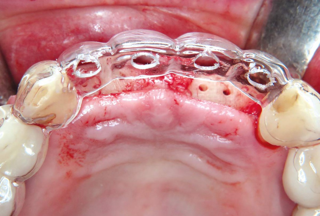 Three-dimensional augmentation with maxgraft® cortico - M.Sc. E. Kapogianni