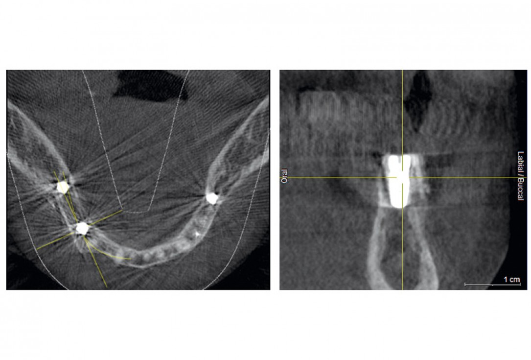Horizontal ridge augmentation with maxgraft® cortico - M.Sc. E. Kapogianni