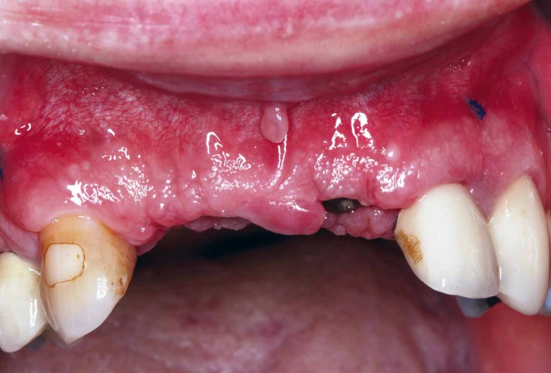 GBR and soft tissue augmentation with cerabone® and mucoderm® - H. Maghaireh & V. Ivancheva