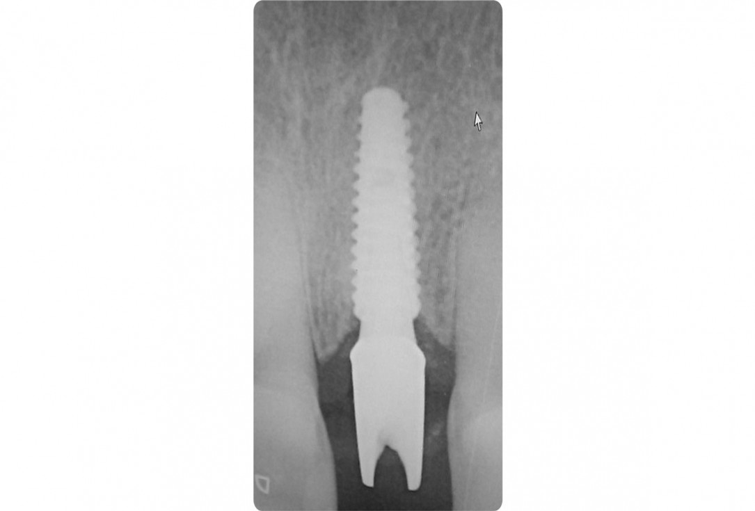 17/18 Tooth extraction and socket sealing with mucoderm® - Dr. A. Rossi