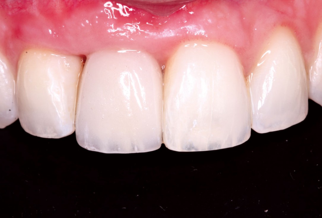 Delayed implant placement with GBR and soft tissue augmentation at the aesthetic area  -  2 years follow up – Dr. H. Maghaireh & Dr. V. Ivancheva