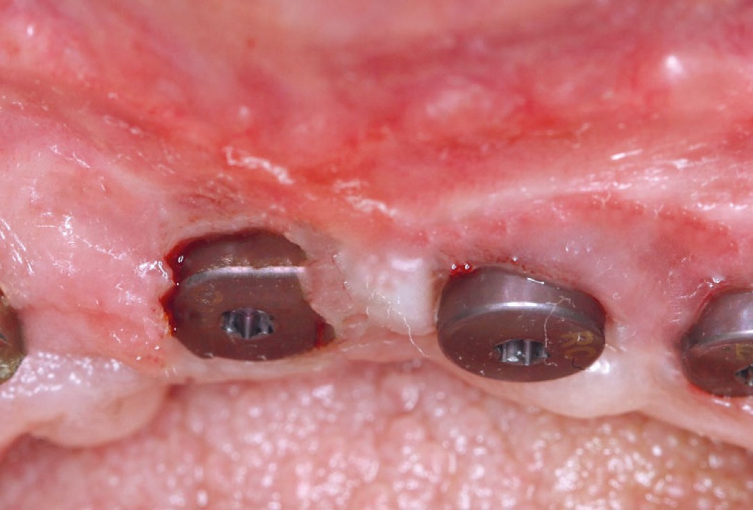 botiss maxgraft® bonebuilder aesthetic reconstruction - Clinical case