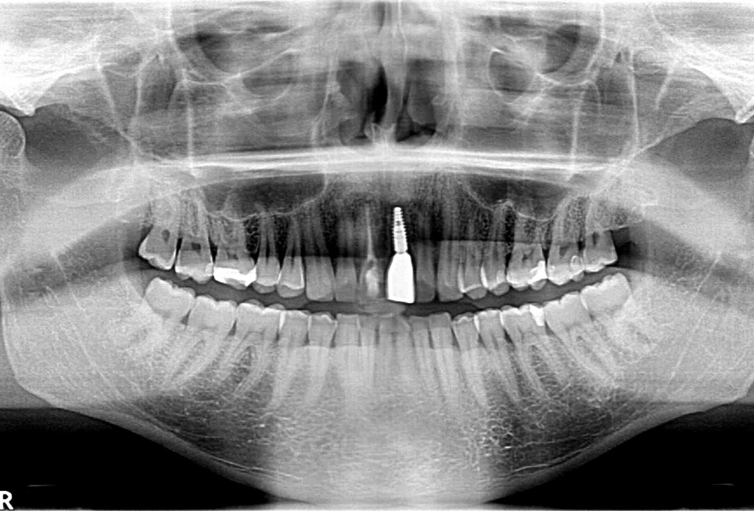 Block augmentation with maxgraft® and cerabone® – Dr. F. Kloss