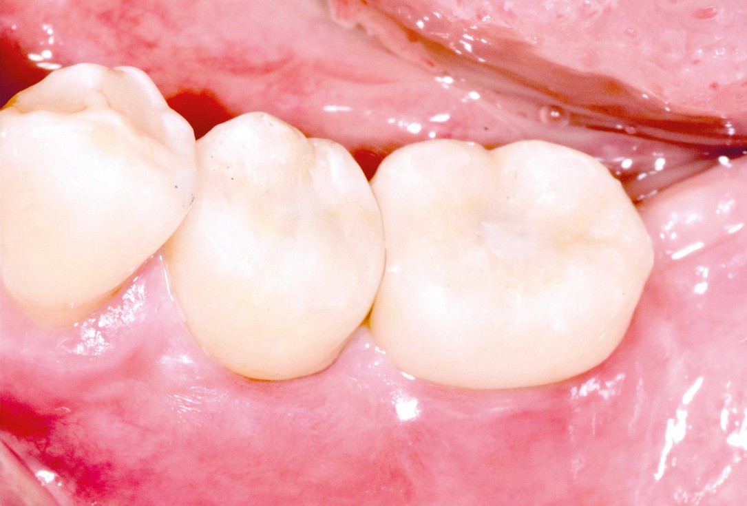 Ridge augmentation in the mandible with maxgraft® bonebuilder– Dr. R. Morger