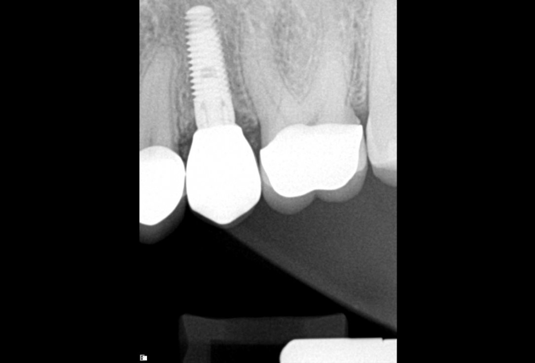 Full bone regeneration in extraction socket augmented with maxgraft® and Jason® membrane – Dr. C. Landsberg