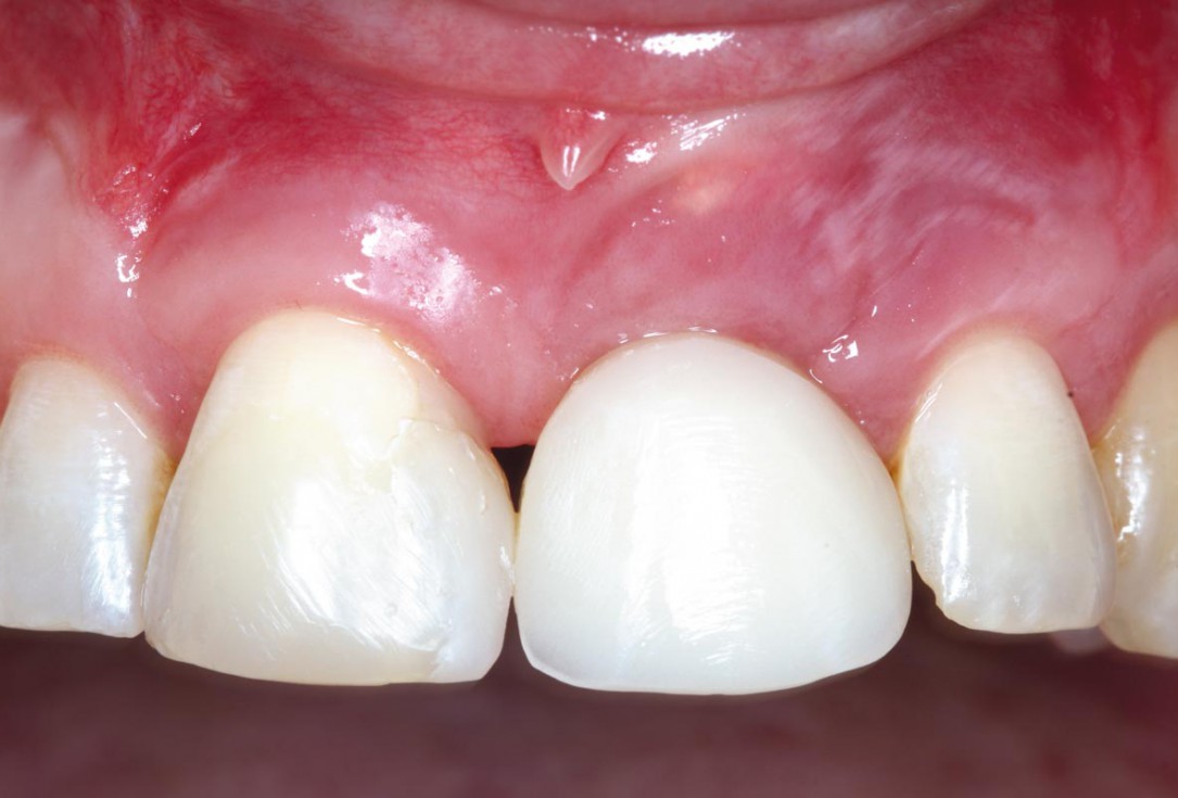 Block grafting in the aesthetic zone with maxgraft®, Jason® membrane and cerabone® - Dres. H. Maghaireh and V. Ivancheva