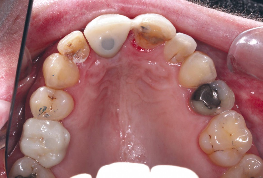 Block grafting in the aesthetic zone with maxgraft®, Jason® membrane and cerabone® - Dres. H. Maghaireh and V. Ivancheva