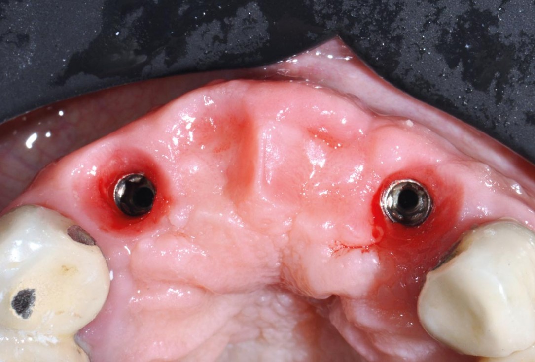 Hard and soft tissue management in immediate restoration