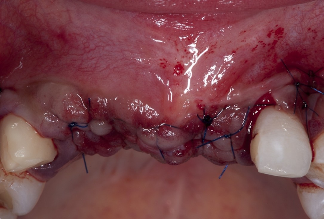Block augmentation with maxgraft® block and mucoderm® - Dr. K. Chmielewski