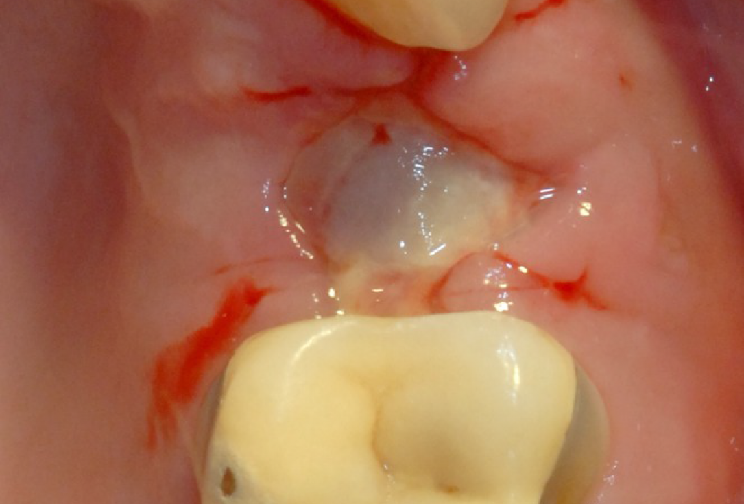 Ridge preservation with cerabone® and Jason® membrane - Dr. Derk Siebers