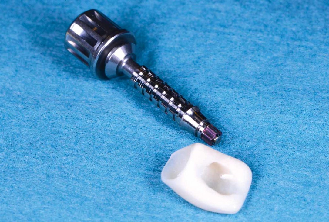 Excellent aesthetic result of buccal augmentation with mucoderm® and maxgraft® after immediate implant placement - 3-years follow-up - Dr. A. Puišys 