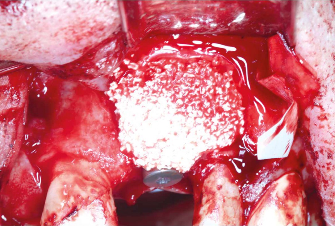 GBR using layering technique in aesthetic zone with maxgraft® and cerabone® -Dr. H. Maghaireh and Dr. V. Ivancheva