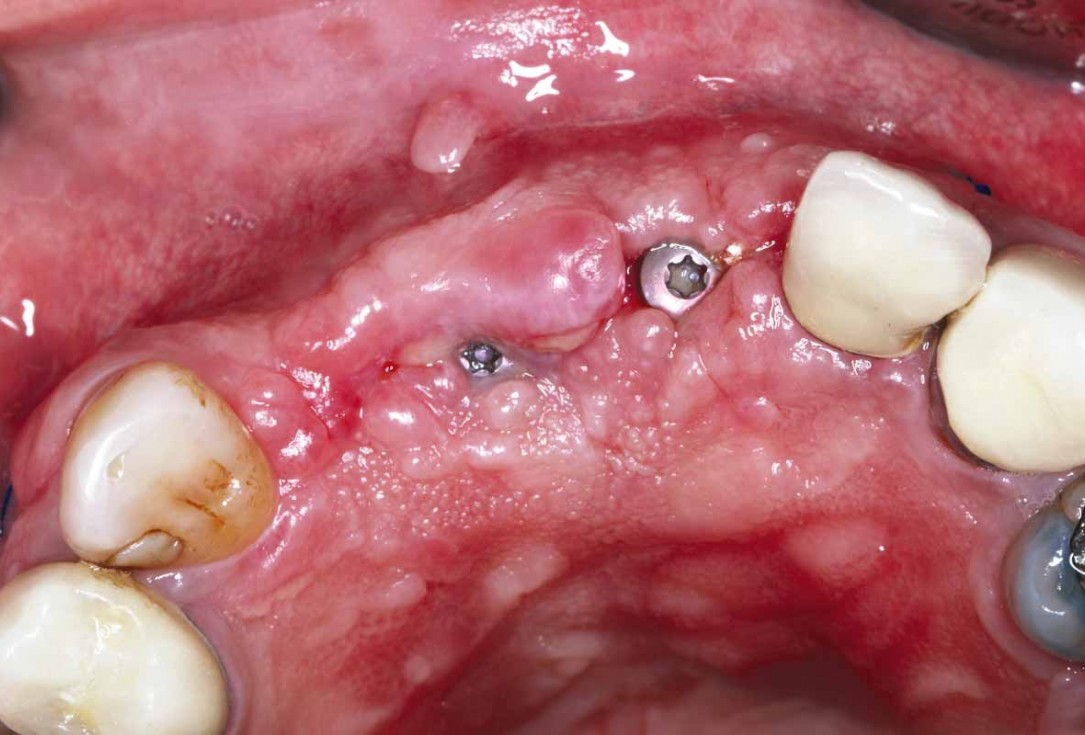 GBR and soft tissue augmentation with cerabone® and mucoderm® - H. Maghaireh & V. Ivancheva