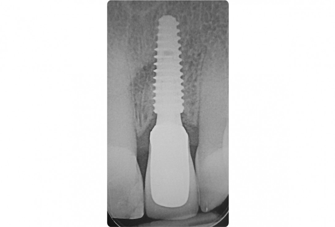 18/18 Tooth extraction and socket sealing with mucoderm® - Dr. A. Rossi