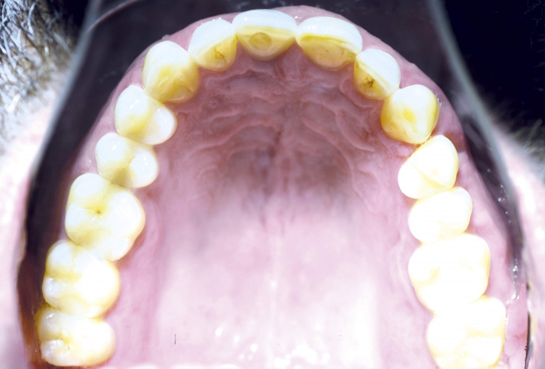 Block augmentation with maxgraft® and cerabone® – Dr. F. Kloss