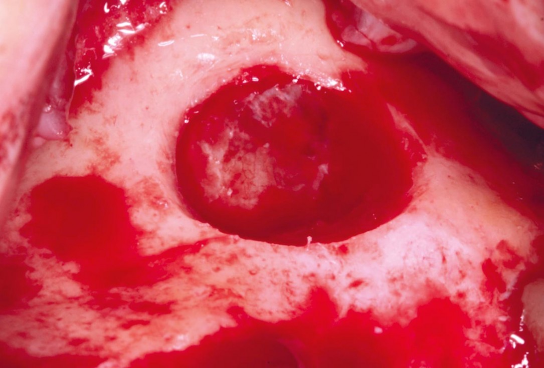 Maxillary sinus cyst removal using the Crocodile Technique and subsequent lateral sinus lift with cerabone®, maxgraft® and Jason® membrane - Dres. C. Scognamiglio and A. Perucchi 