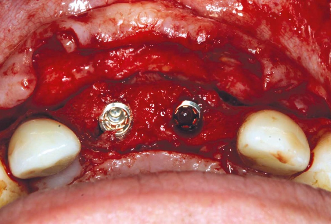 Ridge augmentation in the maxilla with maxgraft® bonebuilder in the aesthetic zone - Dr. M. Kristensen