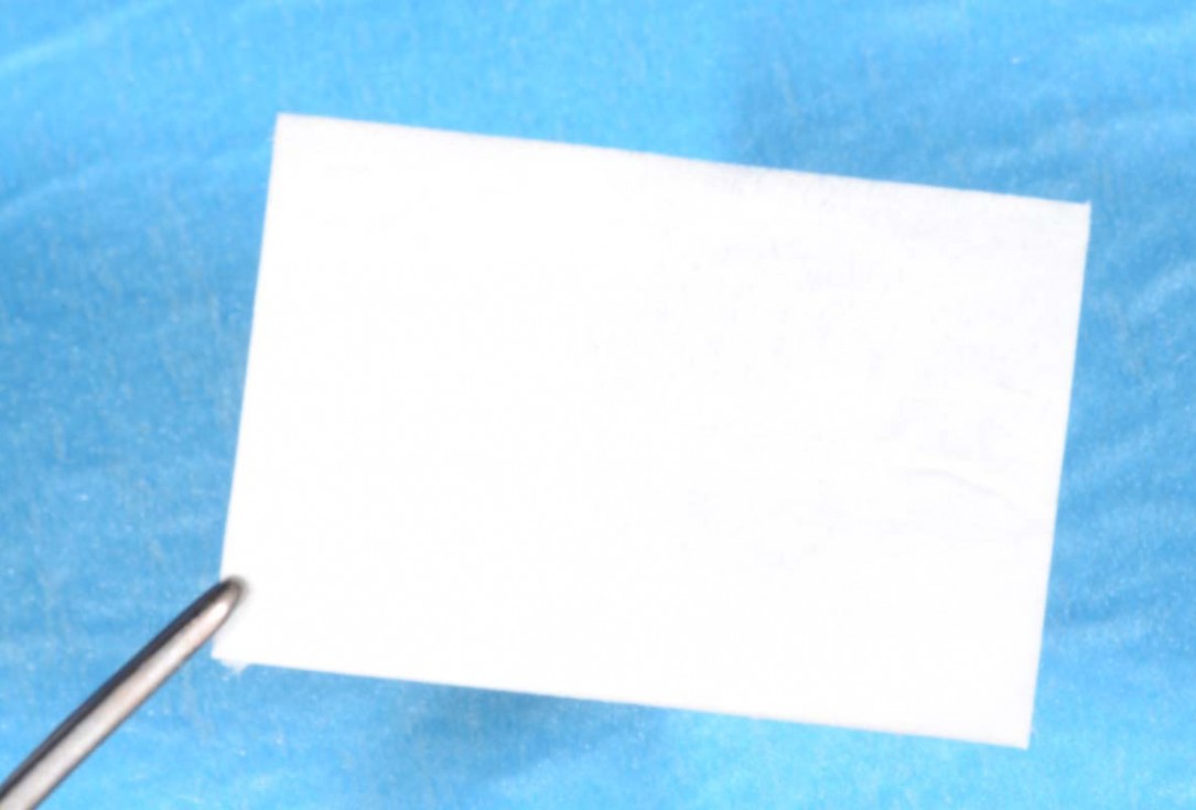 Vertical bone augmentation and broadening of attached gingiva using cerabone, permamem and mucoderm  -  Dr. R. Naimoli