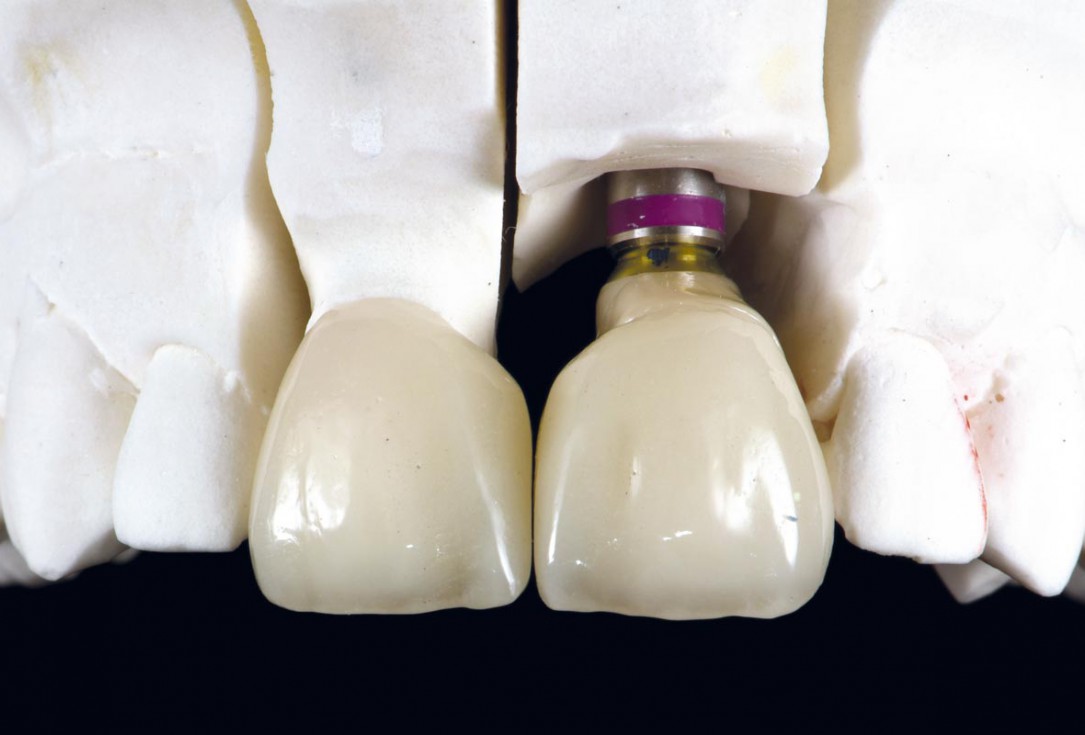 Block grafting in the aesthetic zone with maxgraft®, Jason® membrane and cerabone® - Dres. H. Maghaireh and V. Ivancheva