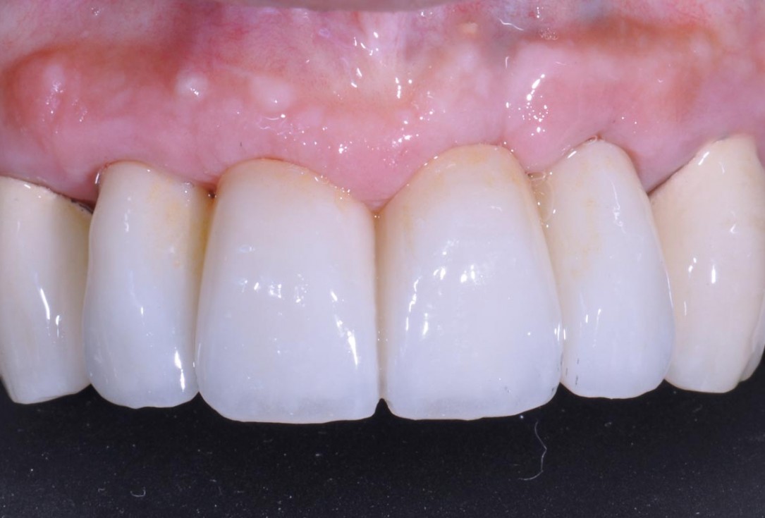 Hard and soft tissue management in immediate restoration