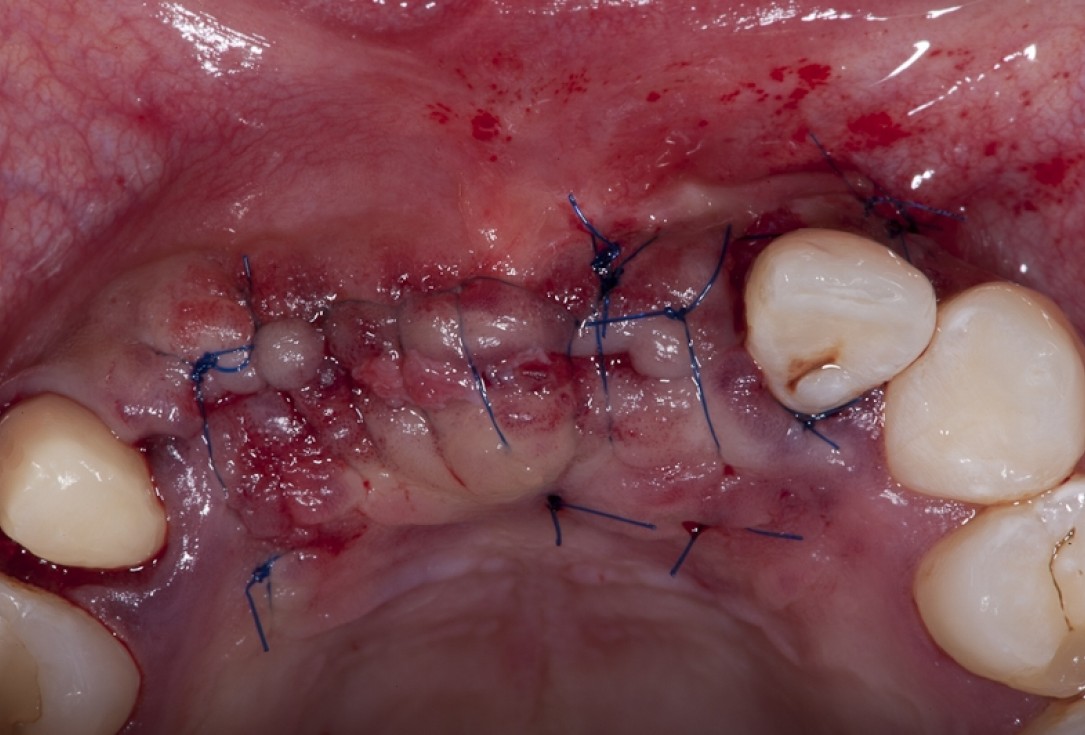 Block augmentation with maxgraft® block and mucoderm® - Dr. K. Chmielewski