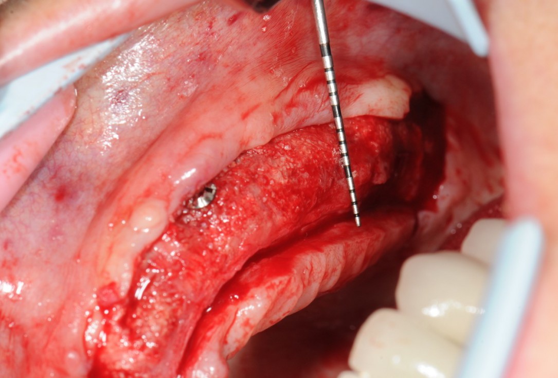 Reconstruction of maxillary ridge with maxgraft® block - Amit Patel