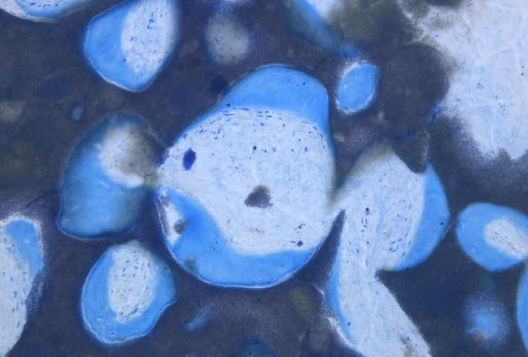 18/20 GBR with maxresorb® and Jason® membrane - Prof. Dr. Dr. D. Rothamel