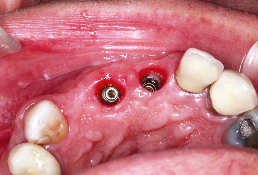 GBR and soft tissue augmentation with cerabone® and mucoderm® - H. Maghaireh & V. Ivancheva