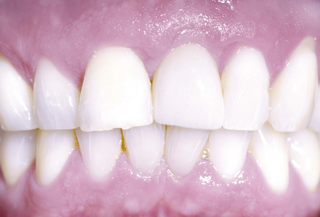 Block augmentation with maxgraft® and cerabone® – Dr. F. Kloss