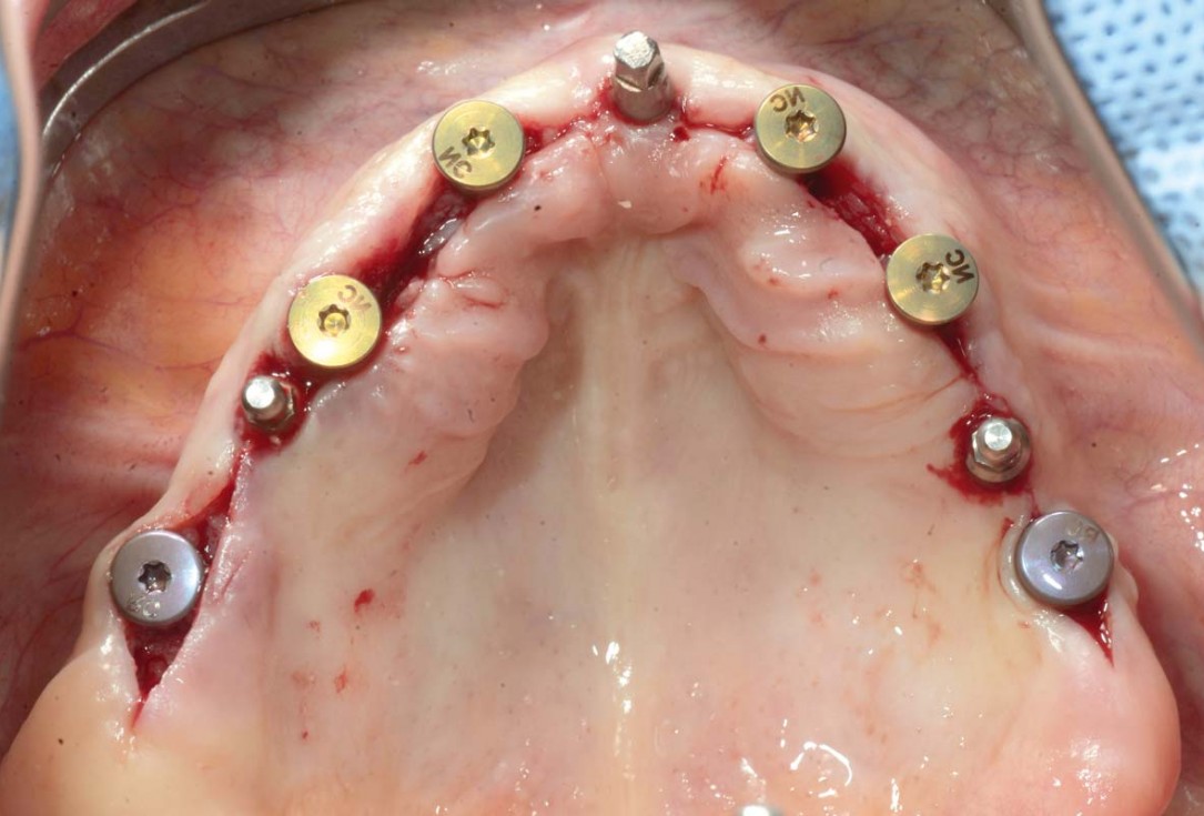 Full arch GBR using botiss cerabone®, maxgraft® and Jason® membrane with simultaneous implantation of 6 Straumann® implants - Dres. A. Signorio and G. Molina