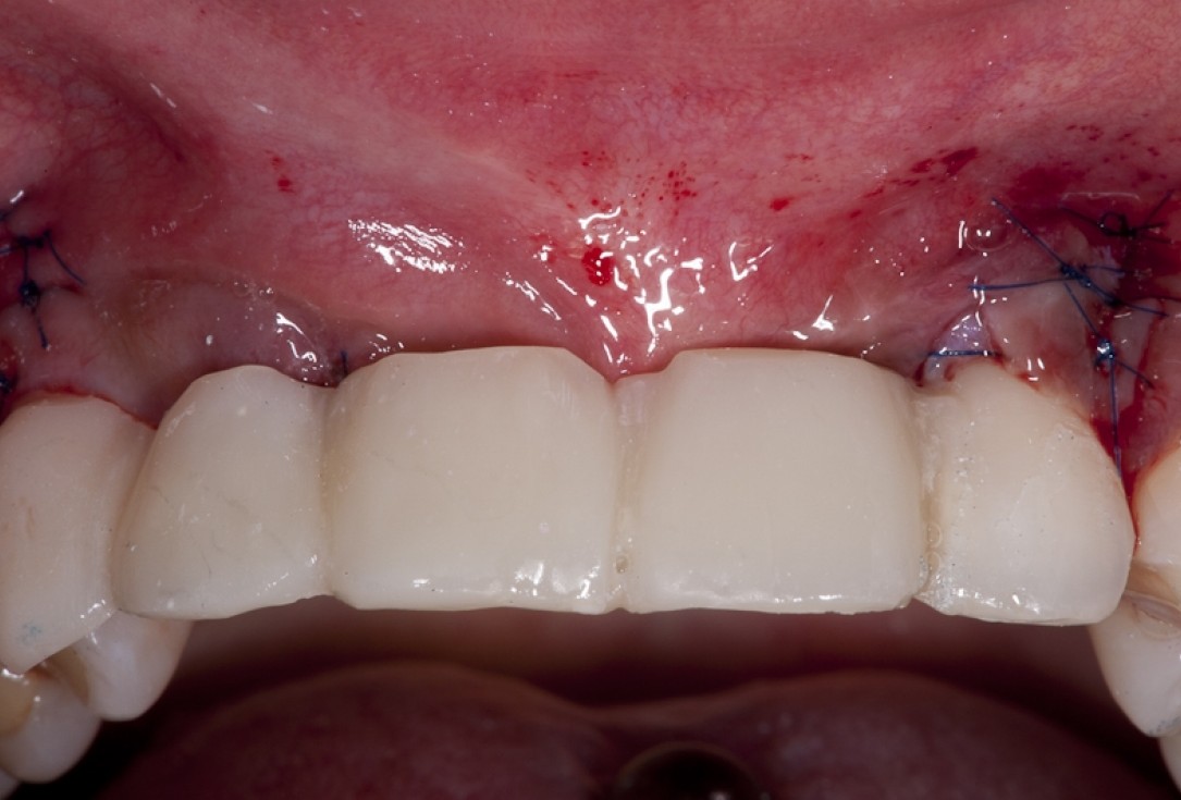 Block augmentation with maxgraft® block and mucoderm® - Dr. K. Chmielewski