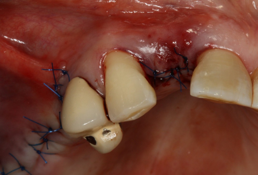 19/20 GBR with maxresorb® and Jason® membrane - Prof. Dr. Dr. D. Rothamel