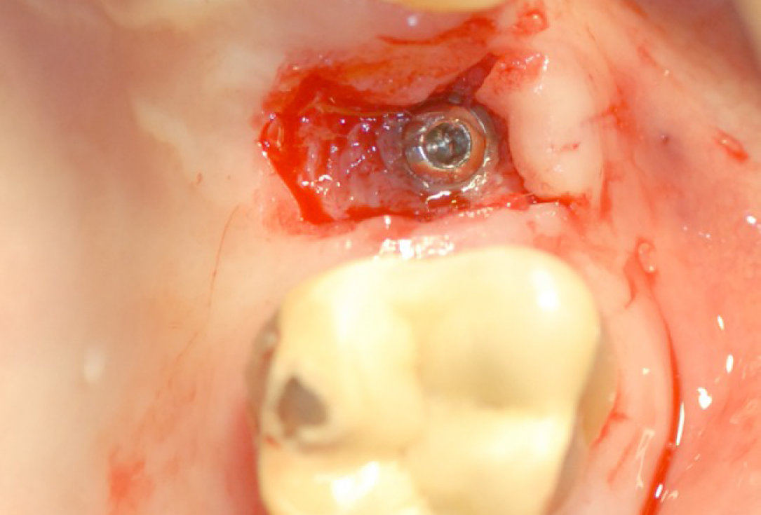 Ridge preservation with cerabone® and Jason® membrane - Dr. Derk Siebers