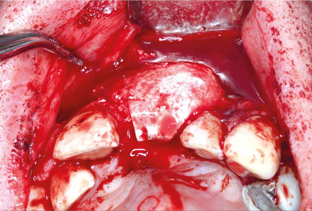 GBR using layering technique in aesthetic zone with maxgraft® and cerabone® -Dr. H. Maghaireh and Dr. V. Ivancheva