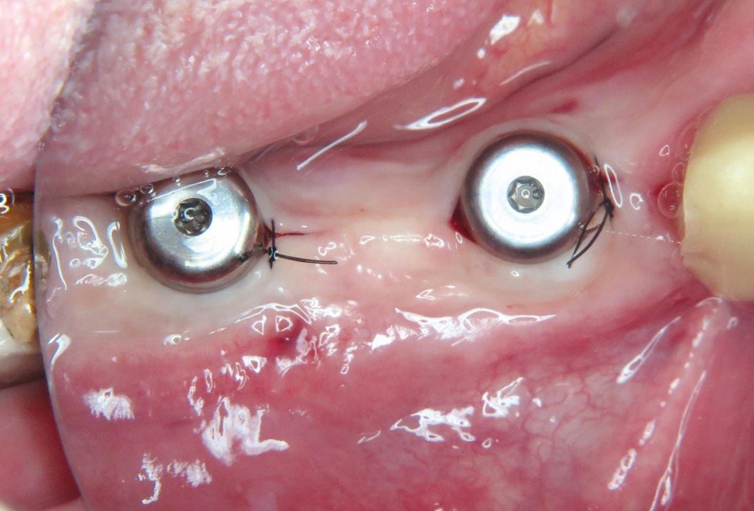 Horizontal ridge augmentation with maxgraft® cortico - M.Sc. E. Kapogianni