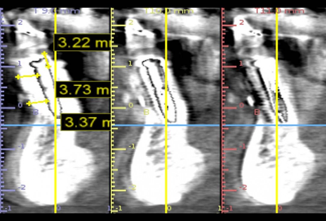 botiss cerabone and mucoderm for bone regeneration and implant supported rehabilitation of a periodontally involved incisor - clinical case