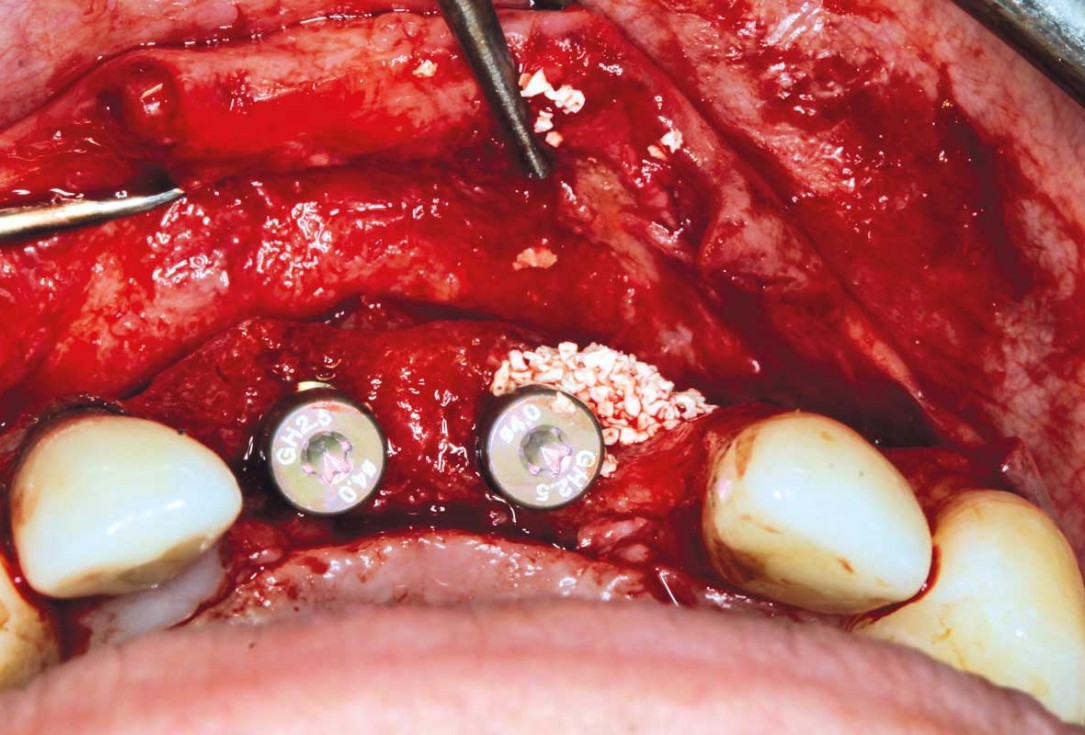 Ridge augmentation in the maxilla with maxgraft® bonebuilder in the aesthetic zone - Dr. M. Kristensen