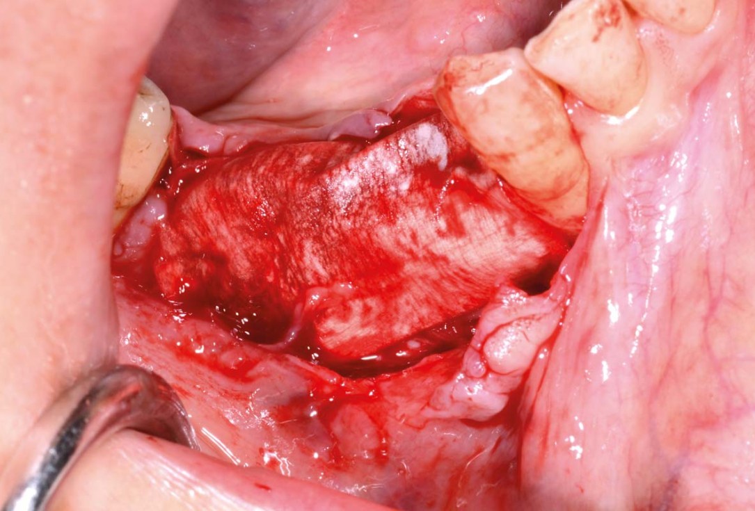 Vertical bone augmentation and broadening of attached gingiva using cerabone, permamem and mucoderm  -  Dr. R. Naimoli