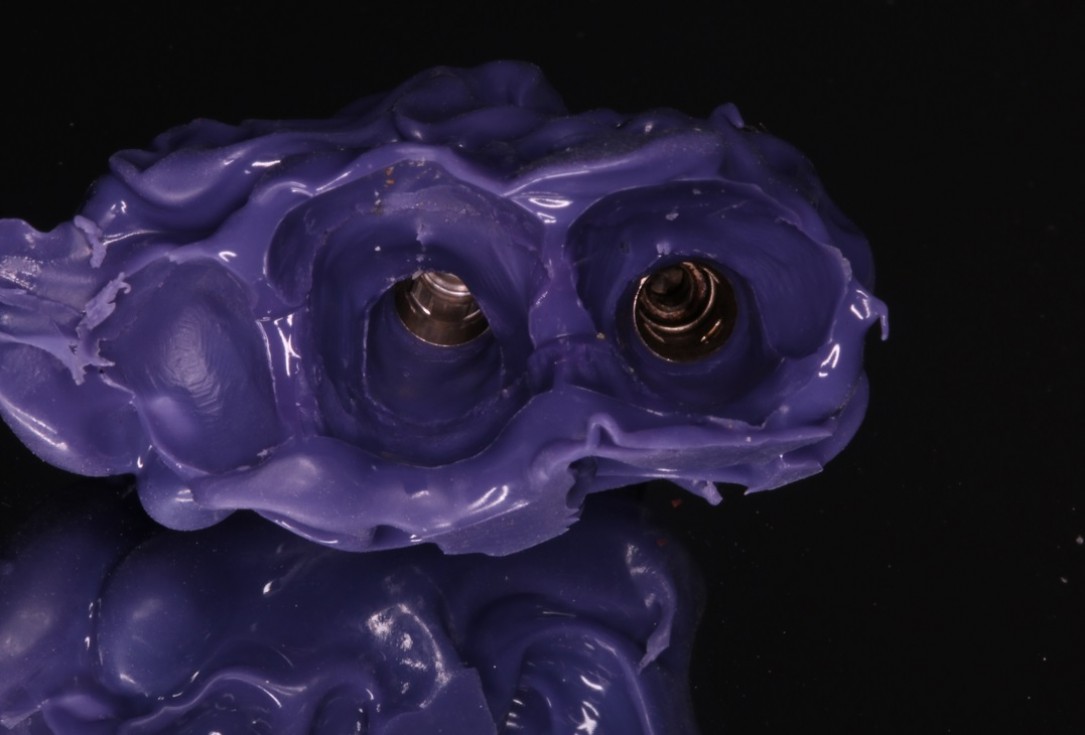 GBR and soft tissue augmentation with cerabone® and mucoderm® - H. Maghaireh & V. Ivancheva