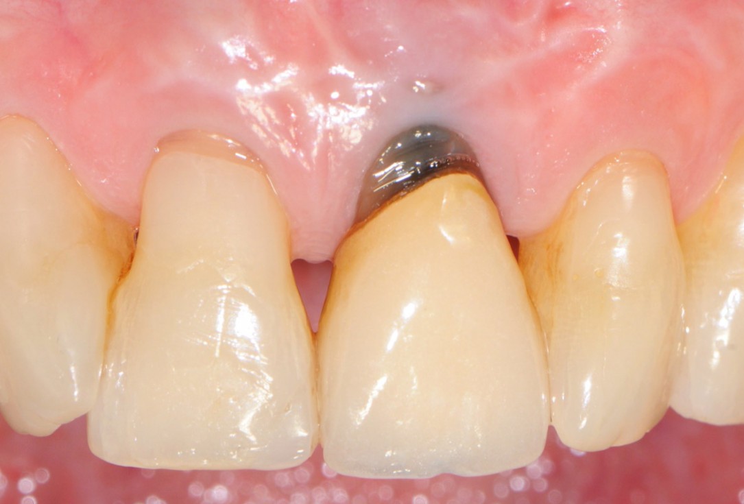 1/18 Tooth extraction and socket sealing with mucoderm® - Dr. A. Rossi