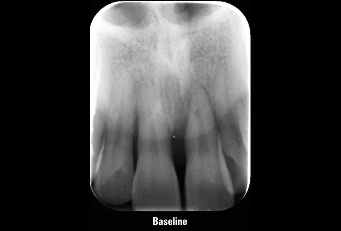 EPP for the treatment of a deep intrabony defect 