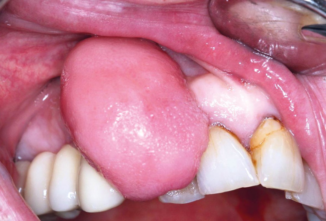 Regeneration with mucoderm® after fibroma resection