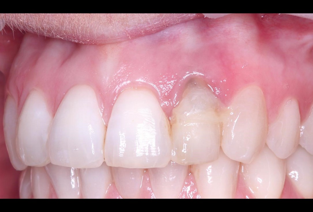 Simultaneous GBR and implantation using maxgraft® granules and autologous bone