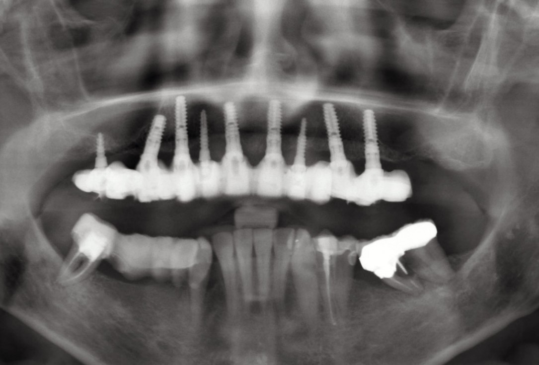 Horizontal ridge augmentation with maxgraft® cortico - M.Sc. E. Kapogianni