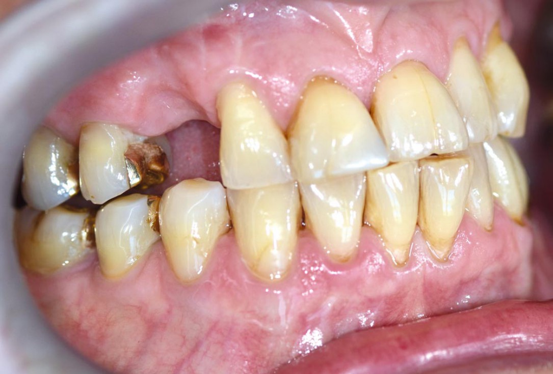 Block augmentation with maxgraft® in the maxilla - PD Dr. Dr. F. Kloss