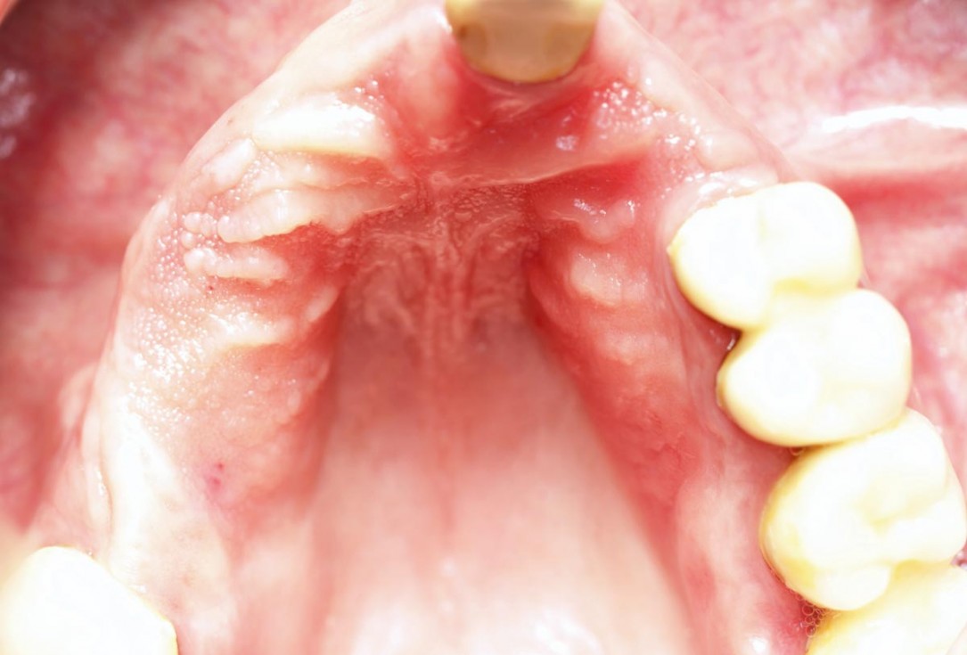 botiss maxgraft® bonebuilder for atrophic maxilla reconstruction - Clinical case